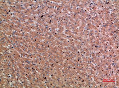Immunohistochemical analysis of paraffin-embedded human-liver-cancer, antibody was diluted at 1:200