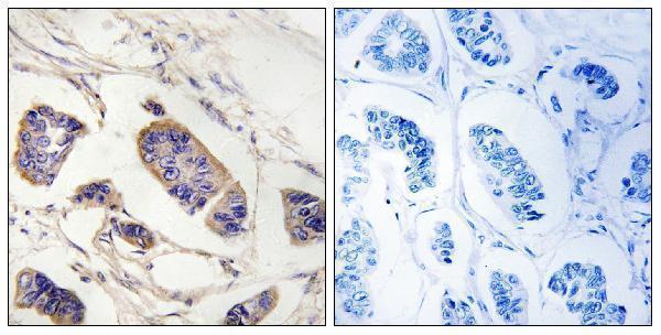 Immunohistochemistry analysis of paraffin-embedded human breast carcinoma tissue, using PEX7 Antibody