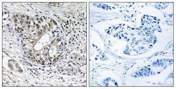 Immunohistochemistry analysis of paraffin-embedded human breast carcinoma tissue, using PNPT1 Antibody
