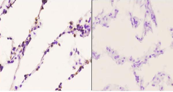Immunohistochemistry (IHC) analyzes of Chemokine Receptor D6 (S383) pAb in paraffin-embedded human lung carcinoma tissue at 1:50