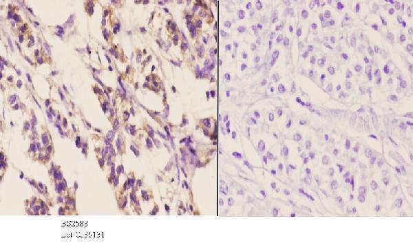 Immunohistochemistry (IHC) analyzes of Chemokine Receptor D6 (S383) pAb in paraffin-embedded human liver carcinoma tissue at 1:50