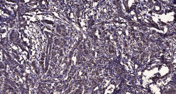 Immunohistochemical analysis of paraffin-embedded human Breast cancer