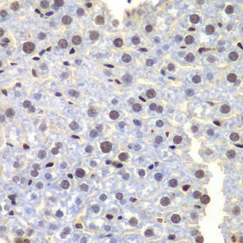 Immunohistochemistry of paraffin-embedded human kidney cancer using LHX4 antibody  at dilution of 1:100 