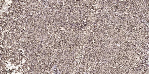 Immunohistochemical analysis of paraffin-embedded human small intestinal carcinoma tissue