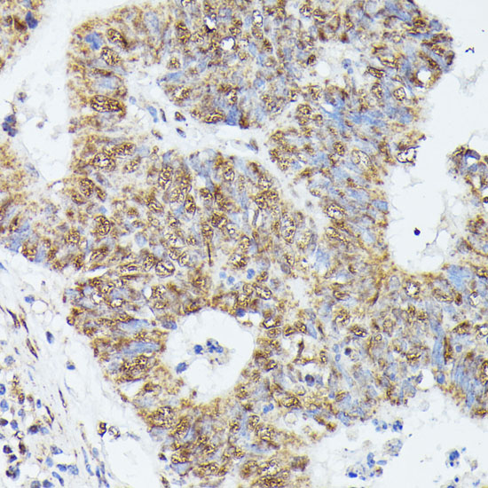 Immunohistochemistry of paraffin-embedded human colon carcinoma using KIF22 antibody  at dilution of 1:100 