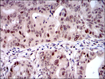 Immunohistochemistry analysis of paraffin-embedded rectum cancer tissues with DAB staining using KID Monoclonal Antibody