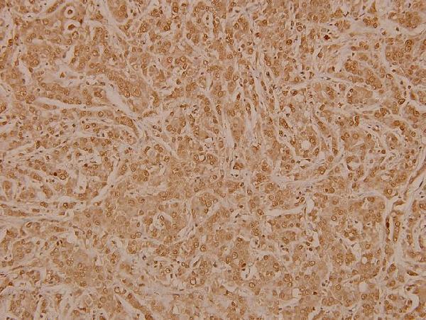 Immunohistochemistry (IHC) analyzes of CD3EAP (E474) pAb in paraffin-embedded human breast carcinoma tissue at 1:100