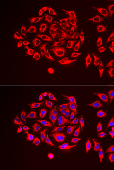 Immunohistochemistry of paraffin-embedded human esophageal cancer using TUFM antibody  at dilution of 1:100 