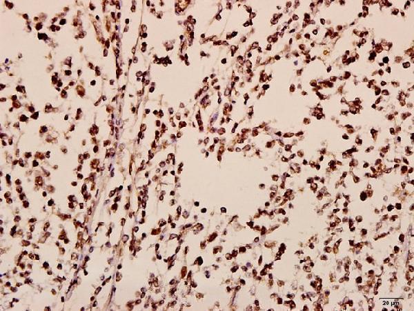 Immunohistochemistry (IHC) analyzes of TIS11B (D88) pAb in paraffin-embedded human tonsil carcinoma tissue at 1:50