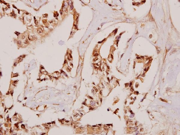 Immunohistochemistry (IHC) analyzes of Fibulin-4 (D123) pAb in paraffin-embedded human breast carcinoma tissue at 1:50