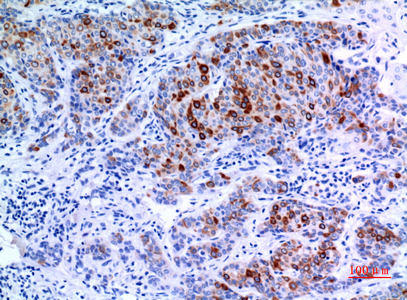 Immunohistochemical analysis of paraffin-embedded human-mammary-cancer, antibody was diluted at 1:100