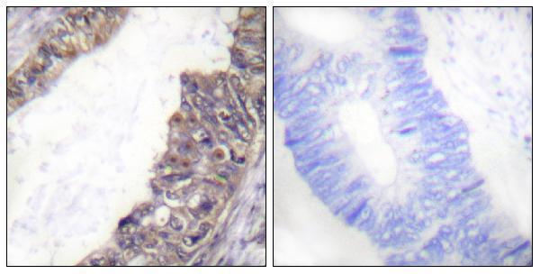 Immunohistochemistry analysis of paraffin-embedded human colon carcinoma, using GIRK1/KIR3