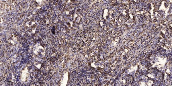 Immunohistochemical analysis of paraffin-embedded human Squamous cell carcinoma of lung