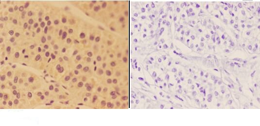 Immunohistochemistry (IHC) analyzes of ALDH3B2 pAb in paraffin-embedded human liver carcinoma tissue at 1:50,showing cytoplasm and membrane staining