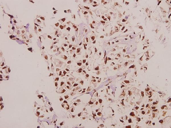 Immunohistochemistry (IHC) analyzes of CPI-17 (K32) pAb in paraffin-embedded human colorectal carcinoma tissue at 1:50