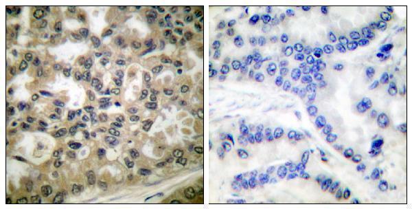 Immunohistochemistry analysis of paraffin-embedded human lung carcinoma, using IkappaB-beta (Phospho-Ser23) Antibody