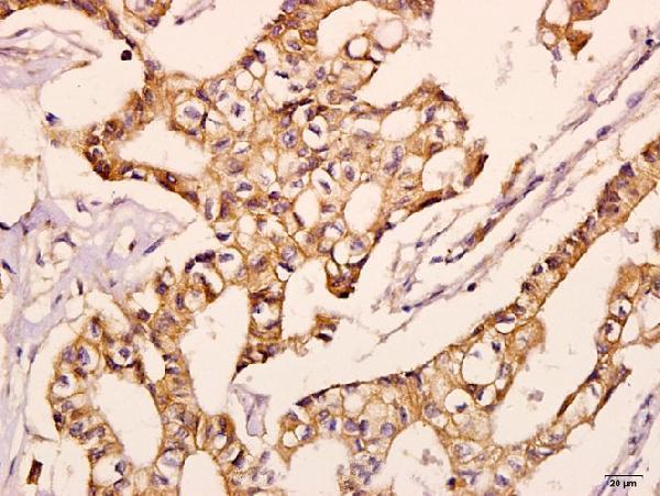 Immunohistochemistry (IHC) analyzes of NDUFV2 (P52) pAb in paraffin-embedded human breast carcinoma tissue at 1:50