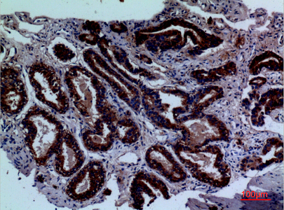 Immunohistochemical analysis of paraffin-embedded human-prostate-cancer, antibody was diluted at 1:100