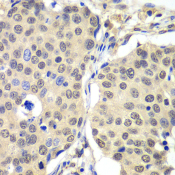 Immunohistochemistry of paraffin-embedded human lung cancer using Cyclin C antibody  at dilution of 1:100 