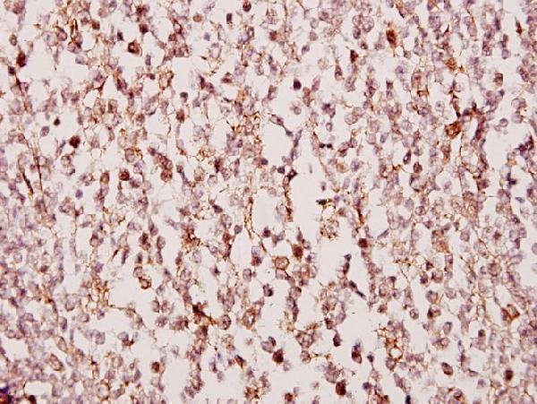Immunohistochemistry (IHC) analyzes of TUSC3 (H153) pAb in paraffin-embedded human tonsil carcinoma tissue at 1:50
