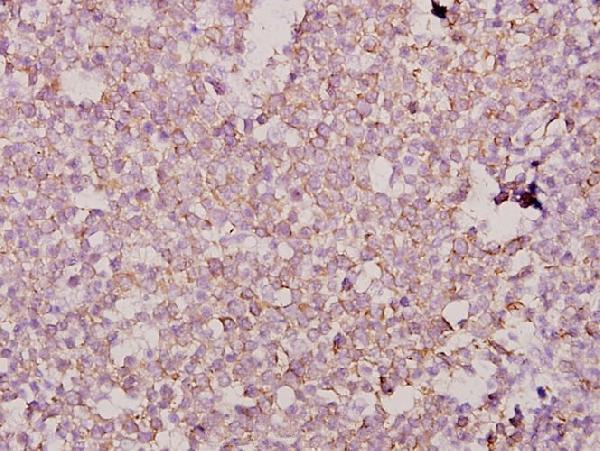 Immunohistochemistry (IHC) analyzes of Dlx-3 (D107) pAb in paraffin-embedded human tonsil carcinoma tissue at 1:50