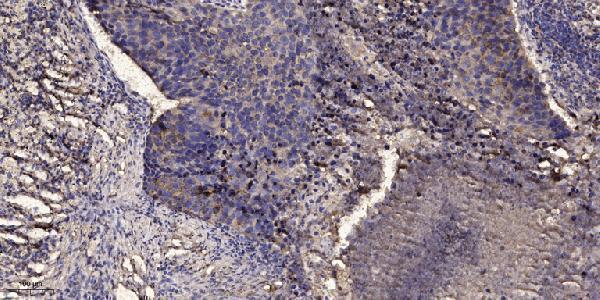 Immunohistochemical analysis of paraffin-embedded human Squamous cell carcinoma of lung