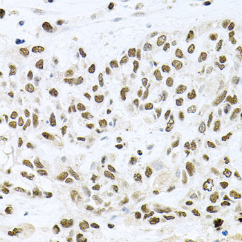 Immunohistochemistry of paraffin-embedded human breast using BCCIP antibody  at dilution of 1:100 