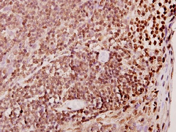 Immunohistochemistry (IHC) analyzes of TDE1 (R392) pAb in paraffin-embedded human tonsil carcinoma tissue at 1:50