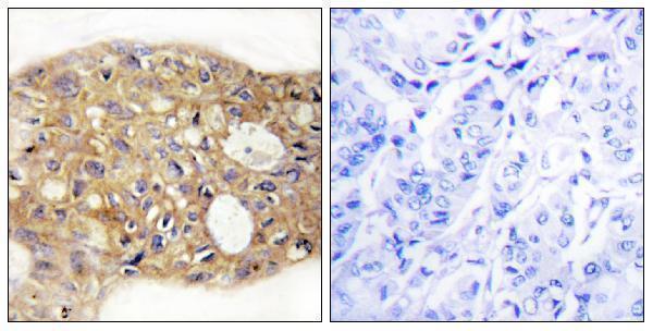 Immunohistochemistry analysis of paraffin-embedded human breast carcinoma tissue, using AGR3 Antibody