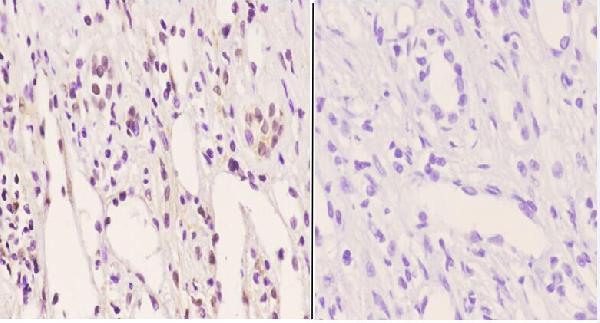 Immunohistochemistry (IHC) analyzes of p-PFKFB2 (S483) pAb in paraffin-embedded human kidney carcinoma tissue at 1:50
