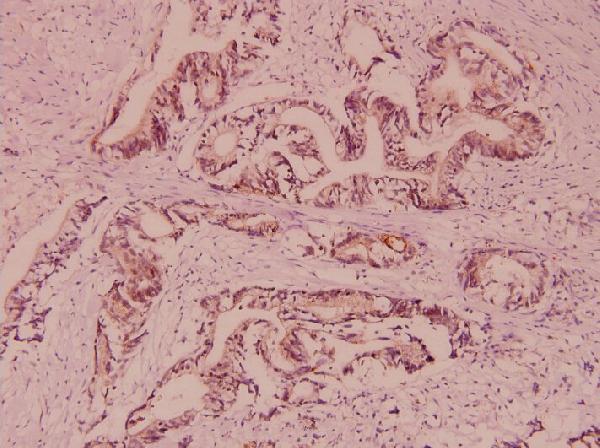Immunohistochemistry (IHC) analyzes of VAMP-1/2/3 (D70) pAb in paraffin-embedded human colorectal cancer carcinoma tissue at 1:100