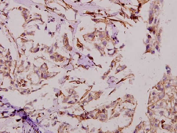 Immunohistochemistry (IHC) analyzes of Dio-1 (S186) pAb in paraffin-embedded human breast carcinoma tissue at 1:50