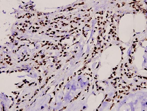 Immunohistochemistry (IHC) analyzes of TBX15/18 (D164) pAb in paraffin-embedded human breast carcinoma tissue at 1:100
