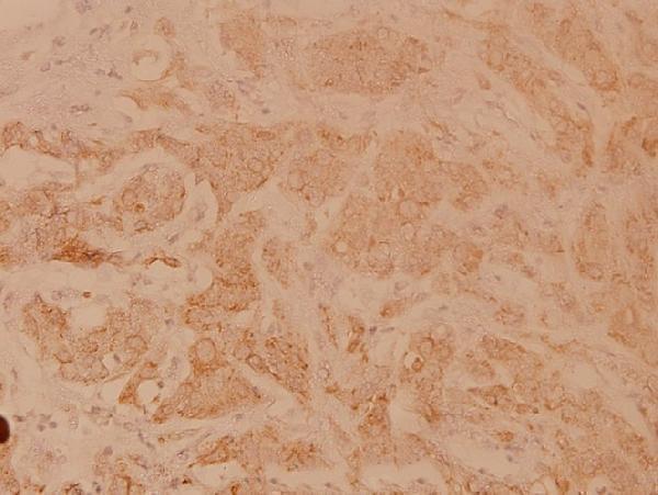 Immunohistochemistry (IHC) analyzes of POLR3A (P68) pAb in paraffin-embedded human breast carcinoma tissue at 1:100