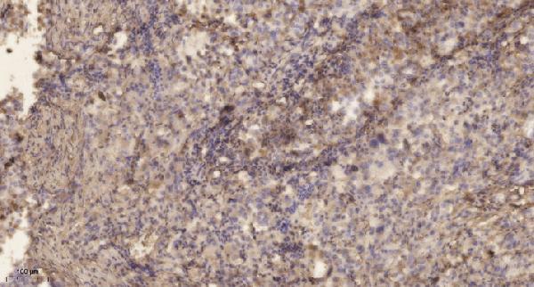 Immunohistochemical analysis of paraffin-embedded human lung cancer