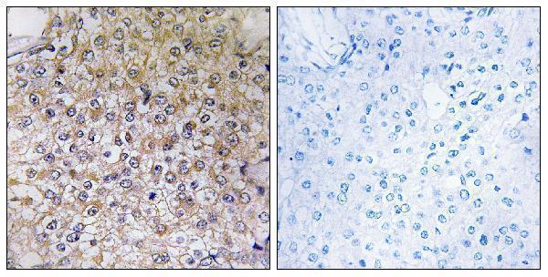 Immunohistochemistryt analysis of paraffin-embedded human breast carcinoma, using ATP6V1B1 Antibody