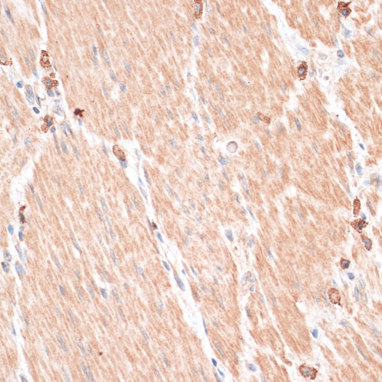 Immunohistochemistry of paraffin-embedded human gastric cancer using ABCB7 antibody  at dilution of 1:100 