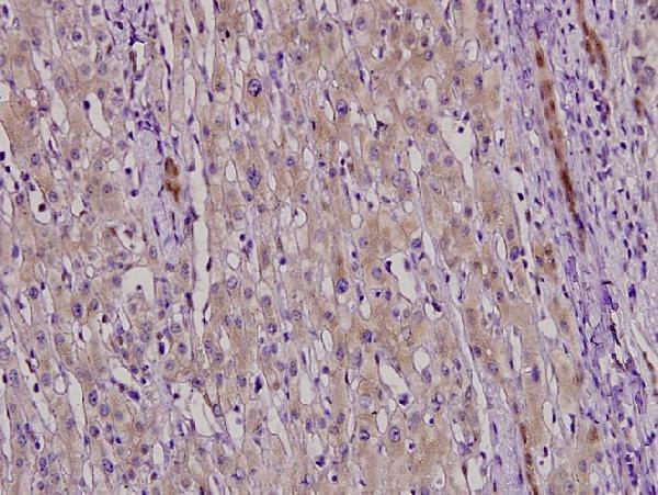 Immunohistochemistry (IHC) analyzes of NF-YC (W85) pAb in paraffin-embedded liver cancer tissue at 1:100