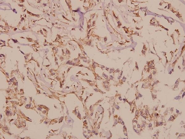 Immunohistochemistry (IHC) analyzes of mGluR-6 (A865) pAb in paraffin-embedded human breast carcinoma tissue at 1:50