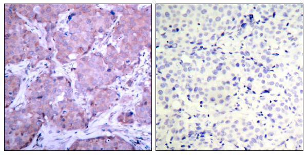 Immunohistochemistry analysis of paraffin-embedded human breast cancer, using PTEN (Phospho-Ser380) Antibody