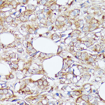 Immunohistochemistry of paraffin-embedded human mammary cancer using SLC7A2 antibody  at dilution of 1:100 