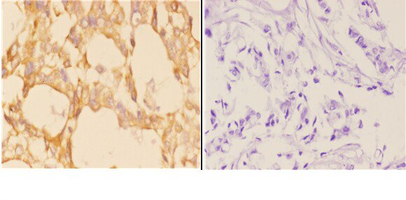Immunohistochemistry (IHC) analyzes of ABCB10 (E479) pAb in paraffin-embedded human breast carcinoma tissue at 1:50,showing membrane staining