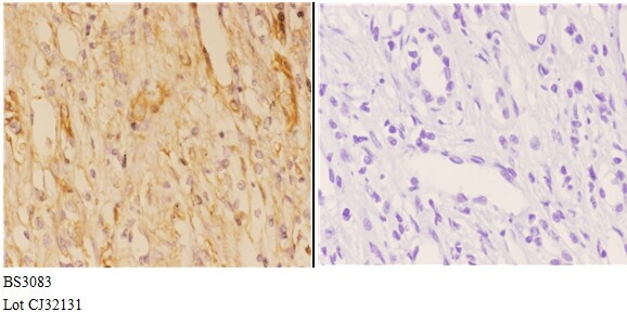 Immunohistochemistry (IHC) analyzes of ABCB10 (E479) pAb in paraffin-embedded human kidney carcinoma tissue at 1:50,showing membrane staining