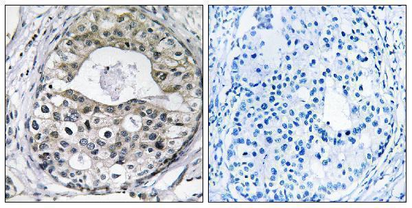 Immunohistochemistry analysis of paraffin-embedded human breast carcinoma tissue, using RPS13 Antibody