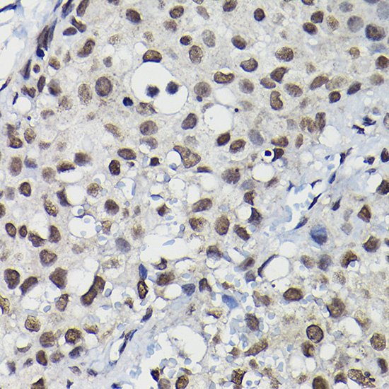 Immunohistochemistry of paraffin-embedded human breast cancer using Cyclin K Rabbit pAb  at dilution of 1:100 