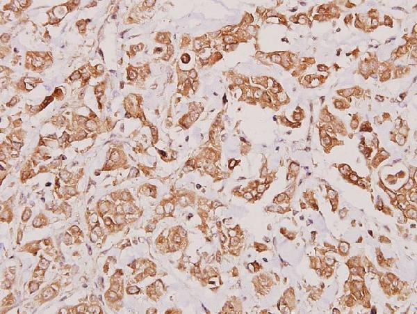 Immunohistochemistry (IHC) analyzes of Granzyme K (H85) pAb in paraffin-embedded human breast carcinoma tissue at 1:100