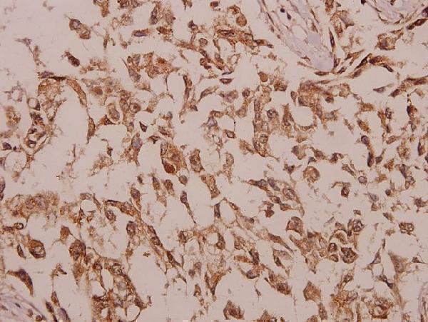 Immunohistochemistry (IHC) analyzes of ChoKB (E324) pAb in paraffin-embedded human colorectal carcinoma tissue at 1:50