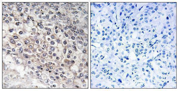 Immunohistochemistry analysis of paraffin-embedded human liver carcinoma tissue, using Cytochrome P450 2W1 Antibody