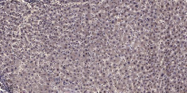Immunohistochemical analysis of paraffin-embedded human liver cancer