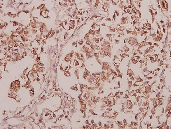 Immunohistochemistry (IHC) analyzes of CEP135 (H1117) pAb in paraffin-embedded human colorectal carcinoma tissue at 1:50